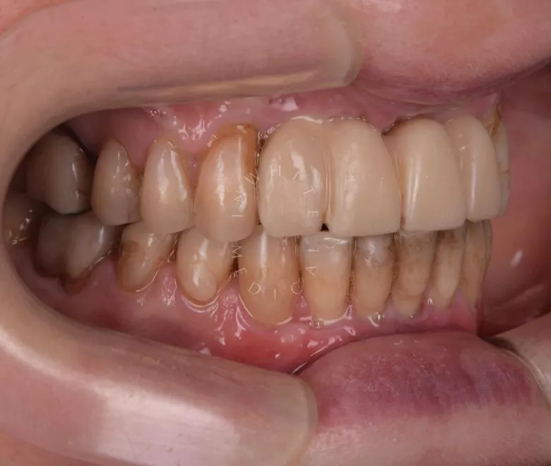 Лучшие клиники стоматологии. Замена старых коронок и установка виниров - фото до процедуры