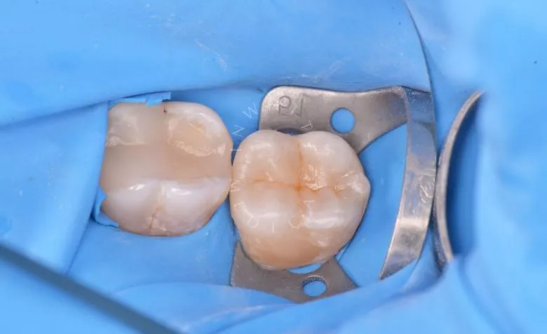 Элитная стоматология. Лечение кариеса жевательного зуба - фото после процедуры