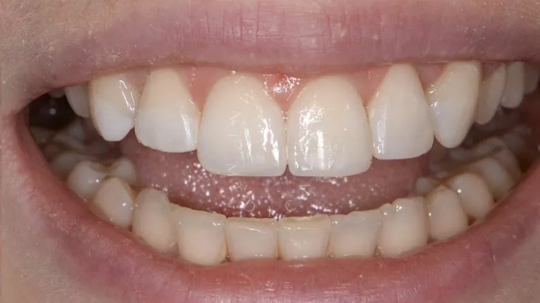 Где лучшая стоматология? Художественная реставрация формы зубов - фото после процедуры