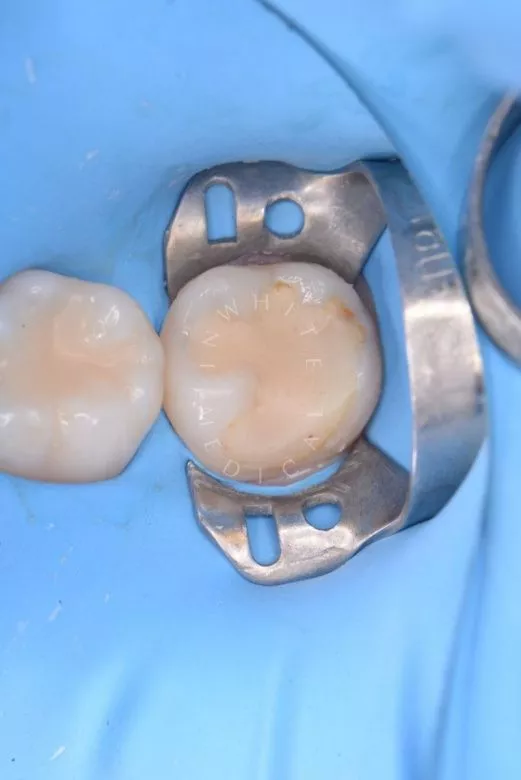 Где лучшая стоматология? Замена  старой пломбы с вторичным кариесом. Реставрация с использованием композитного материала - фото до процедуры