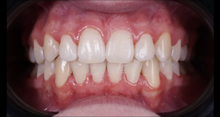 Фото после процедуры