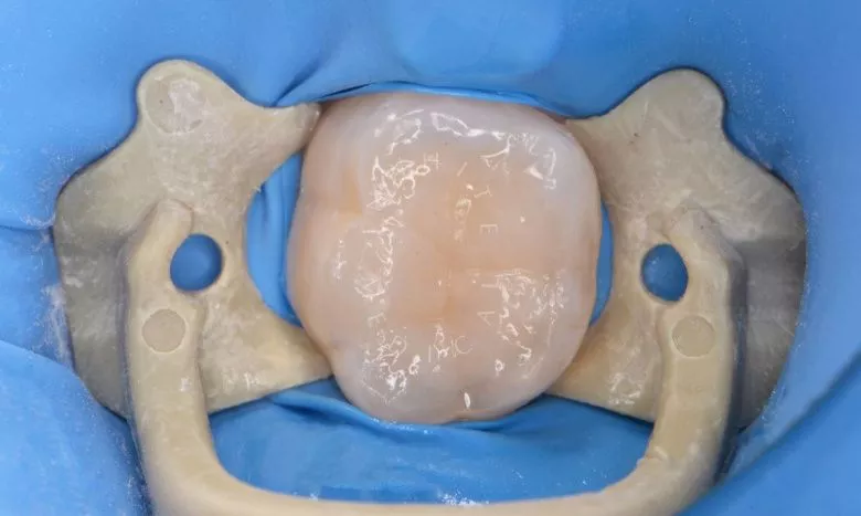 Где лучшая стоматология? Одиночный кариес: лечение и восстановление зуба - фото после процедуры
