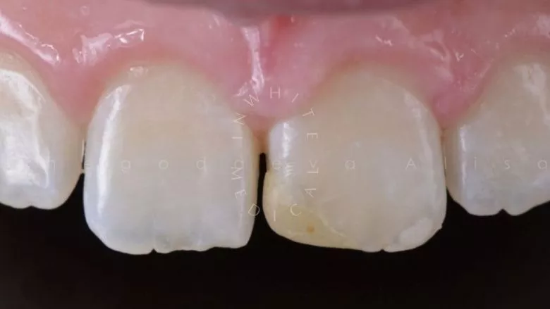 Где лучшая стоматология? Замена старой пломбы. Художественная реставрация зуба с восстановлением оптических характеристик - фото до процедуры