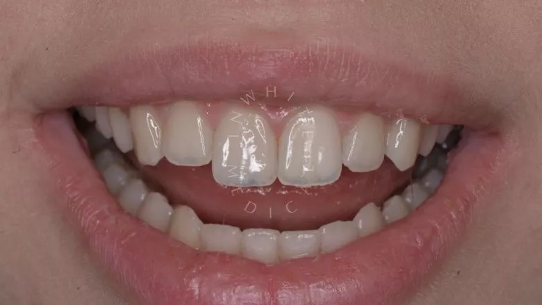 Где лучшая стоматология? Художественная реставрация зуба композитным материалом с восстановлением всех оптических характеристик за один визит. - фото после процедуры