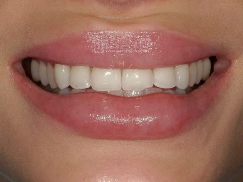 Фото до Отбеливание зубов в Москве в клинике Inwhite Medical