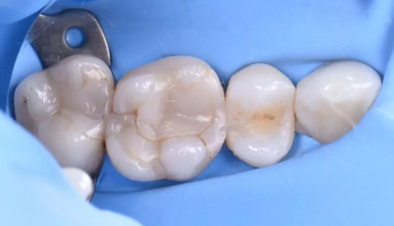 Лучшие зубные клиники Москвы. Средний кариес: лечение и восстановление зуба - фото до процедуры