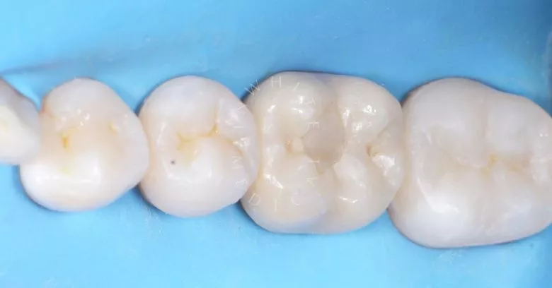 Лучшие стоматологические клиники Москвы. Межзубный кариес зубов и восстановление природной формы фиссур - фото после процедуры