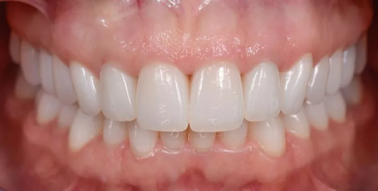 Фото после Улучшение эстетики зоны улыбки 28 керамическими рестоврациями в клинике Inwhite Medical