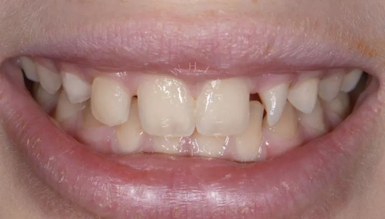 Где лучшая стоматология? Художественная реставрация переднего зуба - фото до процедуры