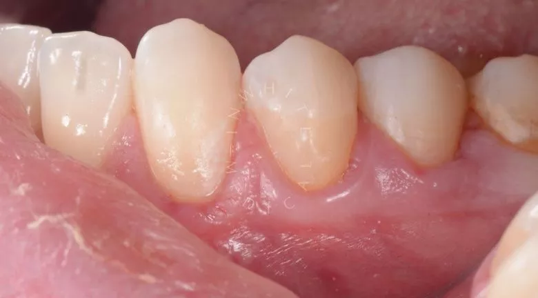 Лучшие зубные клиники Москвы. Пришеечный кариес переднего зуба – художественная реставрация - фото после процедуры