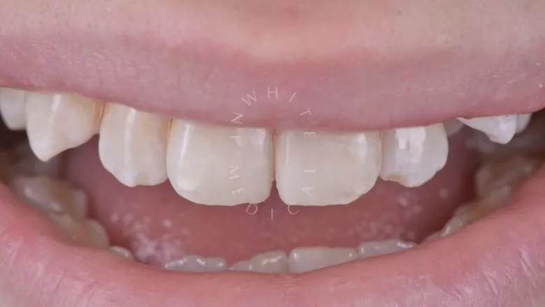 Где лучшая стоматология? Лечение кариеса в эстетически значимой зоне. Реставрация зуба с помощью композита - фото после процедуры