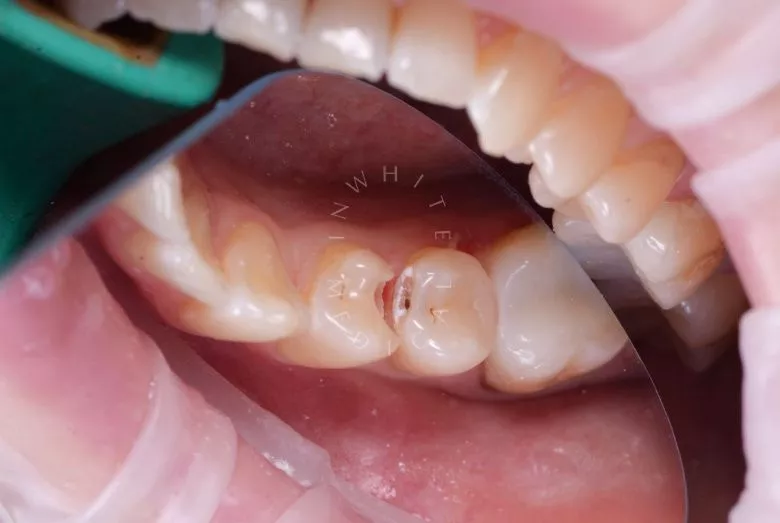 Фото до Восстановление зуба после скола – эстетическая реставрация в клинике Inwhite Medical