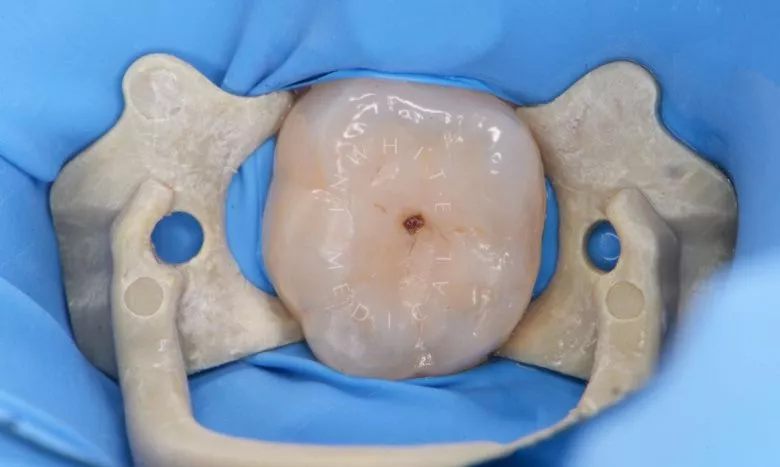 Где лучшая стоматология? Одиночный кариес: лечение и восстановление зуба - фото до процедуры