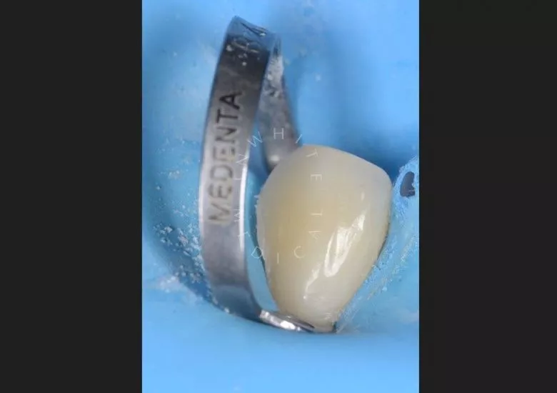 Где лучшая стоматология? Лечение клиновидного дефекта - фото после процедуры