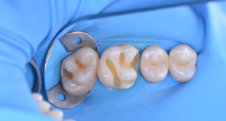 Фото до Комплексное лечение кариесов зубов в клинике Inwhite Medical
