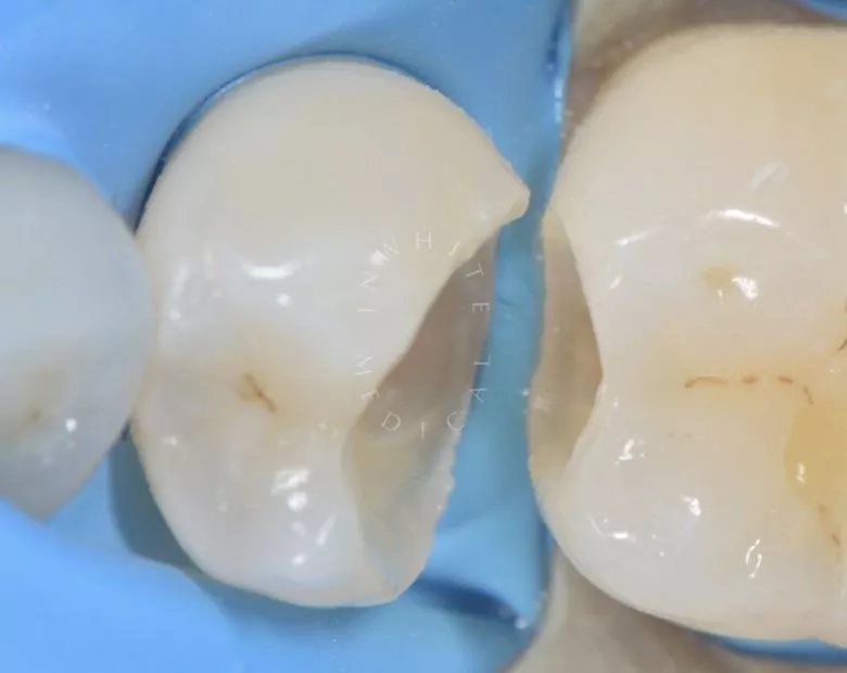 Где лучшая стоматология? Лечение контактного кариеса - фото до процедуры