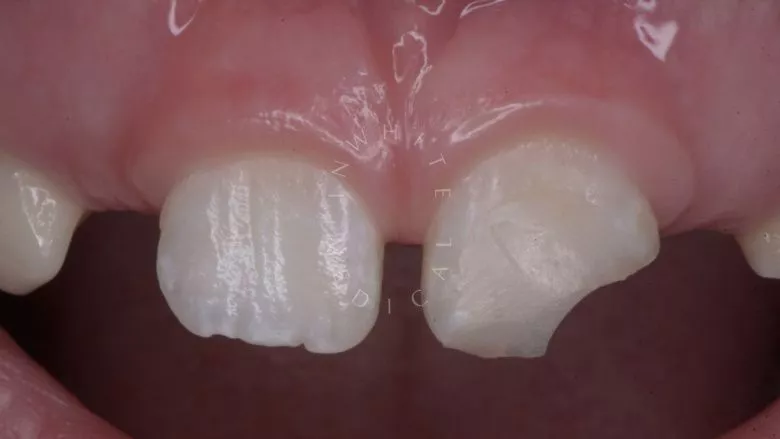 Где лучшая стоматология? Прямая реставрация с использованием композитного материала в одно посещение - фото до процедуры