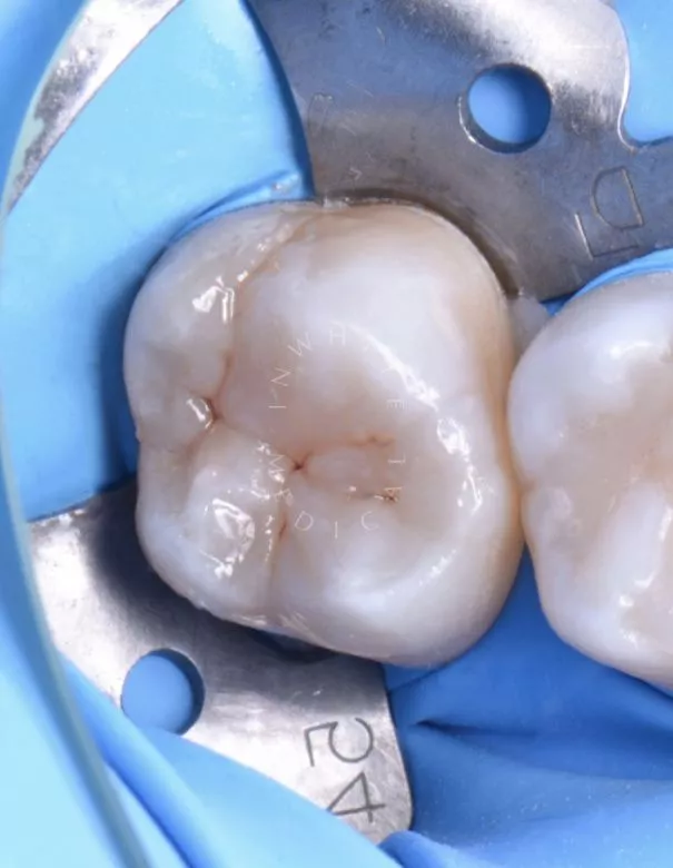 Лучшие стоматологические клиники Москвы. Сложный глубокий кариес – клинический пример - фото после процедуры