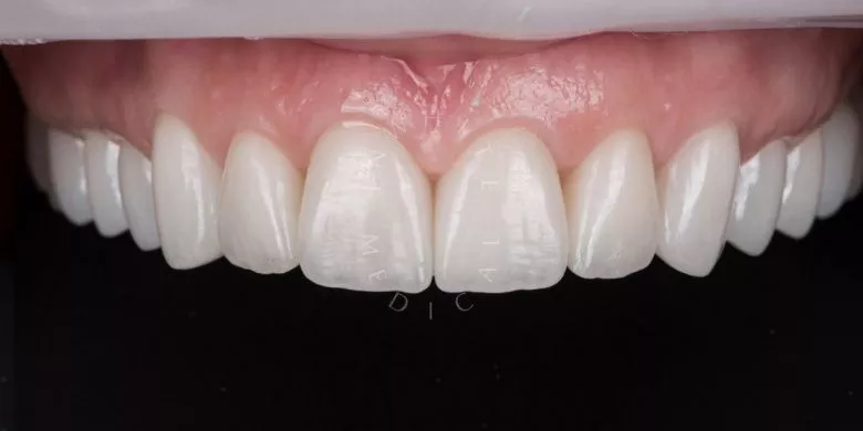 Фото после Эстетическая реабилитация керамическими реставрациями в клинике Inwhite Medical