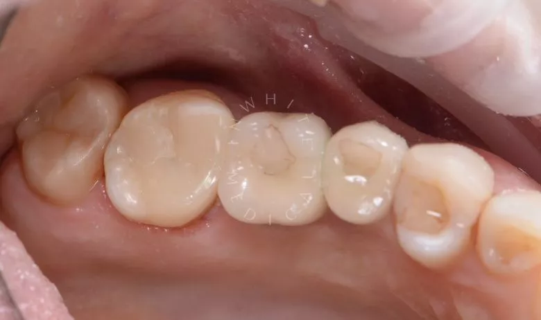 Фото после Лечение скрытого кариеса под старой пломбой в клинике Inwhite Medical