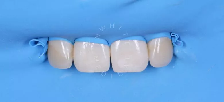 Элитная стоматология. Лечение скрытого межзубного кариеса - фото после процедуры