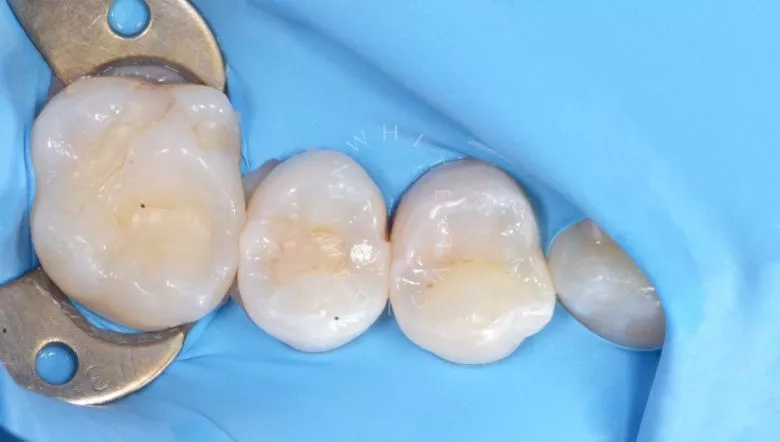 Фото до Контактный кариес с восстановлением контактного пункта в клинике Inwhite Medical