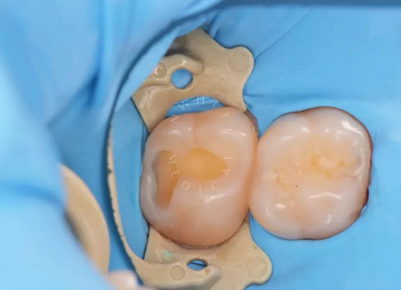 Фото до Глубокий кариес с риском пульпита – терапевтический подход в клинике Inwhite Medical