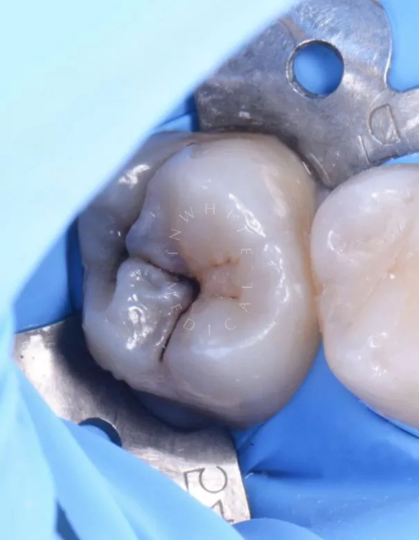 Лучшие стоматологические клиники Москвы. Сложный глубокий кариес – клинический пример - фото до процедуры