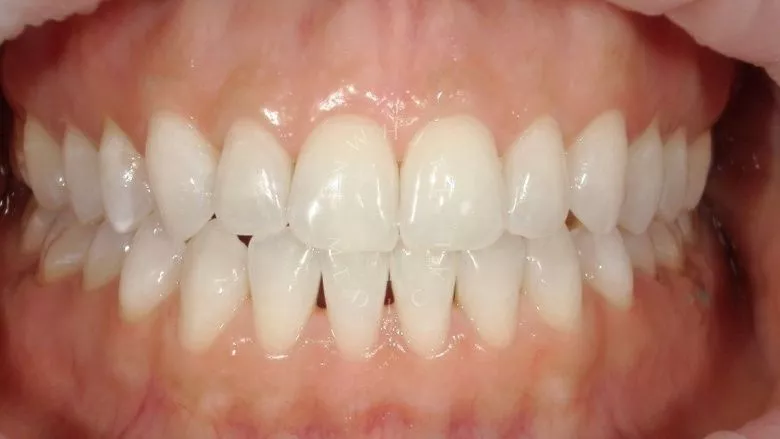 Фото после Отбеливание зубов - результат за одну процедуру в клинике Inwhite Medical