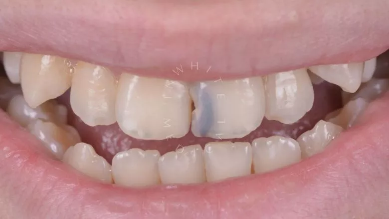 Где лучшая стоматология? Лечение кариеса в эстетически значимой зоне. Реставрация зуба с помощью композита - фото до процедуры