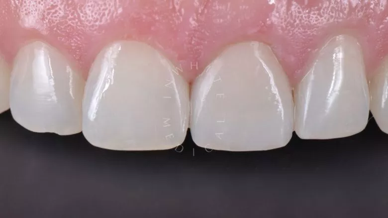 Где лучшая стоматология? Прямая реставрация центрального резца со стекловолоконным штифтом - фото после процедуры