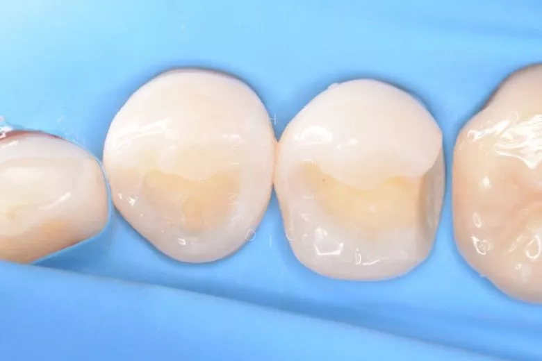 Фото до Лечение контактного кариеса в клинике Inwhite Medical