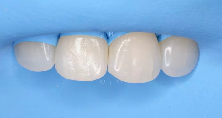 Фото до Лечение межзубного кариеса фронтальных зубов в клинике Inwhite Medical