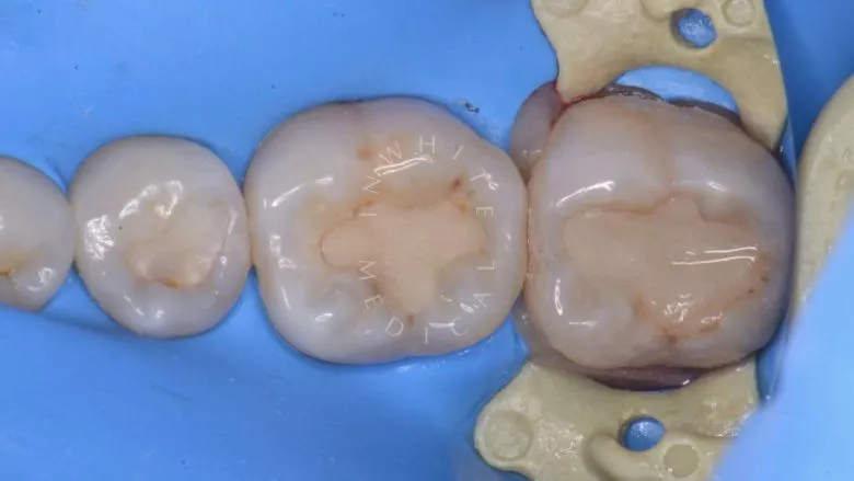 Где лучшая стоматология? Замена старых пломб с лечением кариеса. Восстановление зубов с восстановлением анатомических ориентиров - фото до процедуры