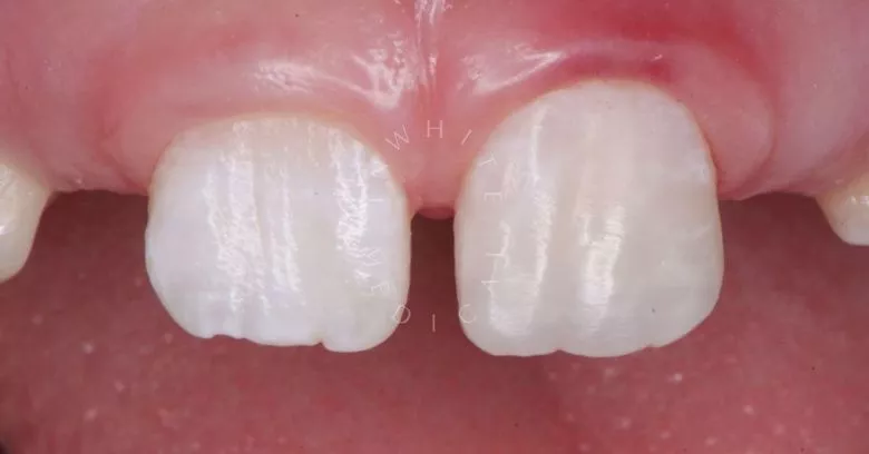 Где лучшая стоматология? Восстановление эстетики фронтального зубы - фото после процедуры