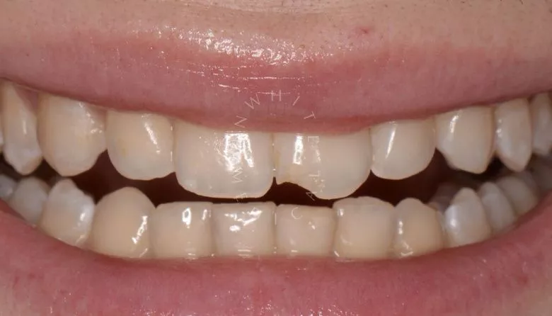 Где лучшая стоматология? Художественная реставрация с использованием композитного материала за один визит - фото до процедуры