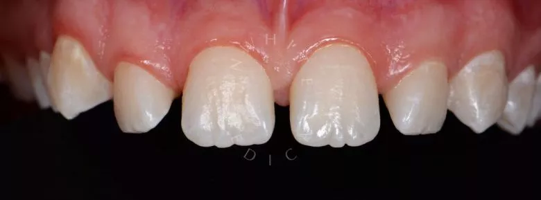 Фото до Эстетические реставрации в зоне улыбки в клинике Inwhite Medical