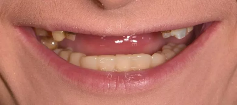 Стоматология премиум. Восстановление эстетики улыбки - установка имплантатов, коронок и виниров - фото до процедуры