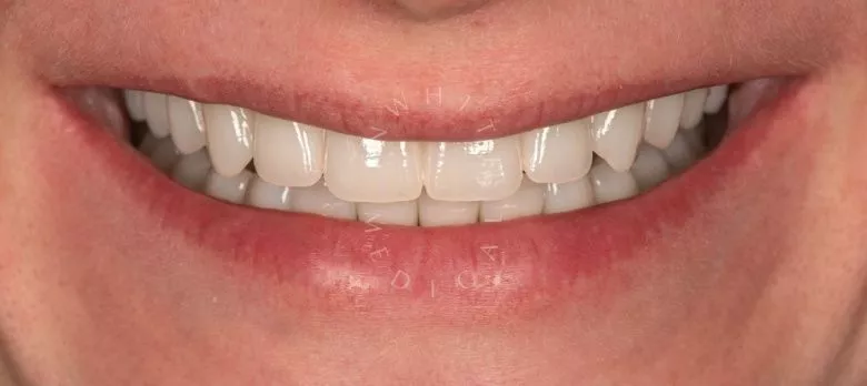 Стоматология премиум. Восстановление эстетики улыбки - установка имплантатов, коронок и виниров - фото после процедуры