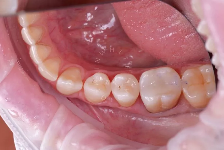 Фото после Восстановление зуба после скола – эстетическая реставрация в клинике Inwhite Medical