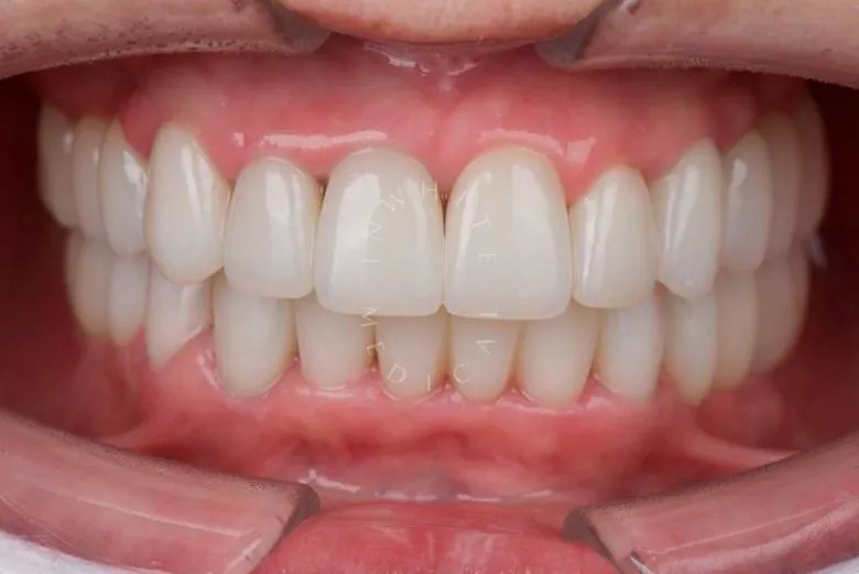 Фото после Тотальная реабилитация керамическими винирами и коронками после имплантации в клинике Inwhite Medical