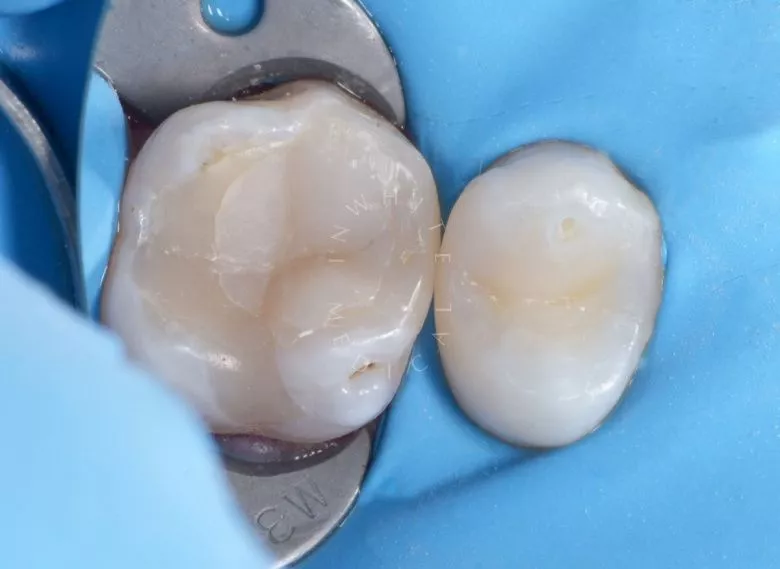 Лучшие зубные клиники Москвы. Скрытый контактный кариес - фото после процедуры