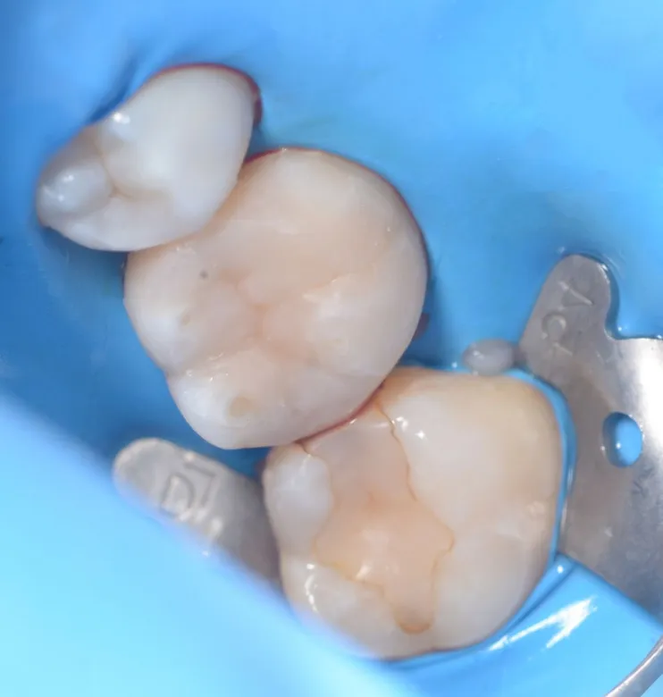 Фото после Глубокий кариес жевательного зуба – сохранение зуба в клинике Inwhite Medical