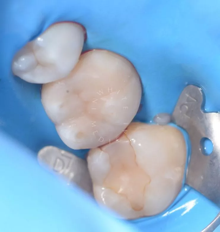 Лучшие стоматологические клиники Москвы. Глубокий кариес жевательного зуба – сохранение зуба - фото после процедуры