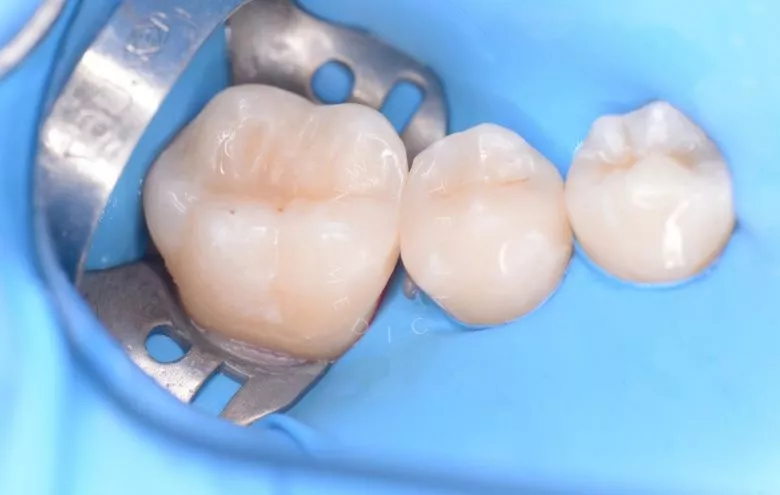 Где лучшая стоматология? Скрытый межзубный кариес – диагностика и лечение - фото после процедуры