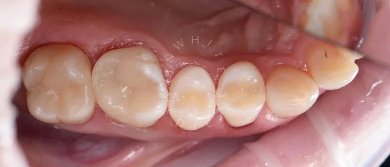 Фото после Лечение 4 зубов за один визит в клинике Inwhite Medical