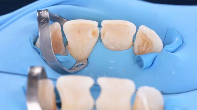 Элитная стоматология. Реставрация фронтальных зубов после лечения кариеса - фото до процедуры