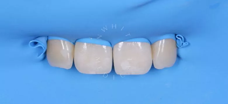 Элитная стоматология. Лечение скрытого межзубного кариеса - фото до процедуры