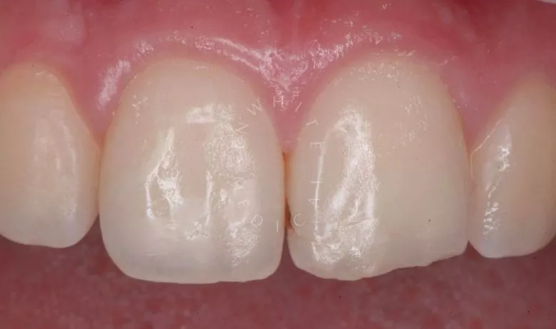 Где лучшая стоматология? Реставрация зуба с восстановлением естественной формы - фото до процедуры