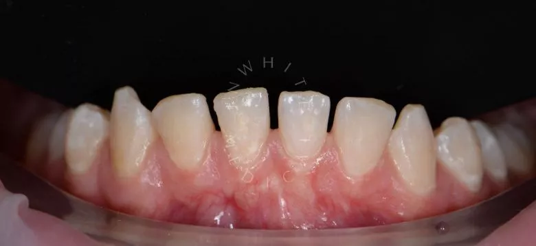 Фото до Восстановление эстетики нижних фронтальных зубов композитными винирами в клинике Inwhite Medical